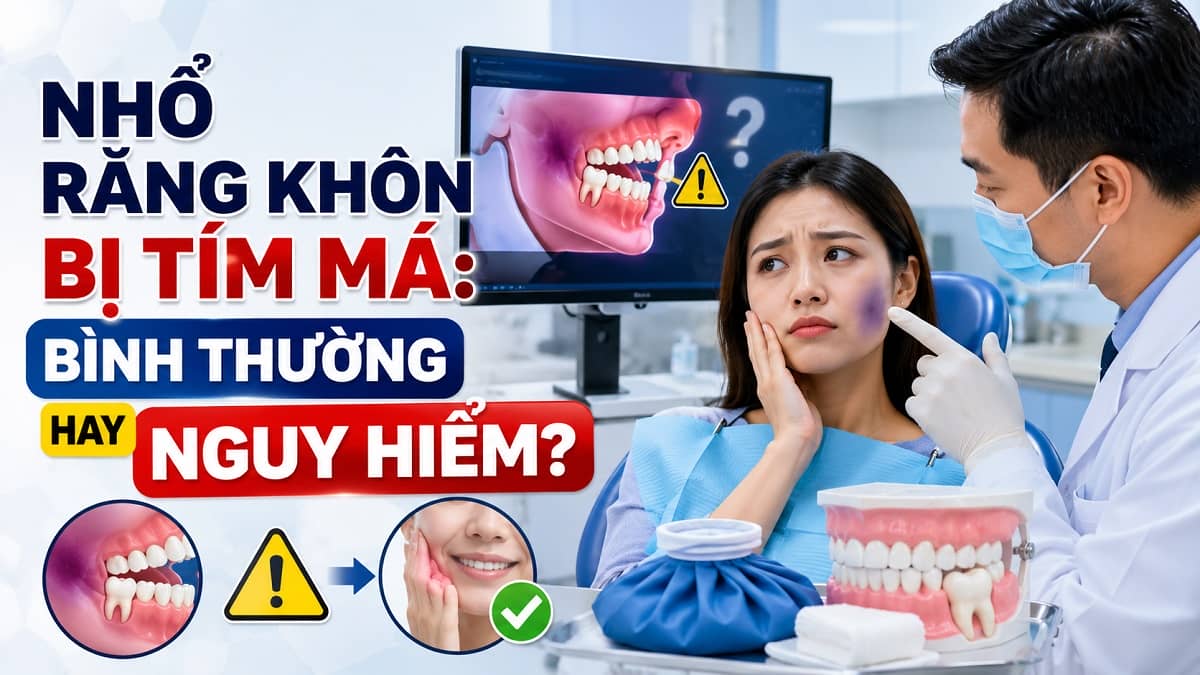 Nhổ Răng Khôn Bị Tím Má: Bình Thường Hay Nguy Hiểm?